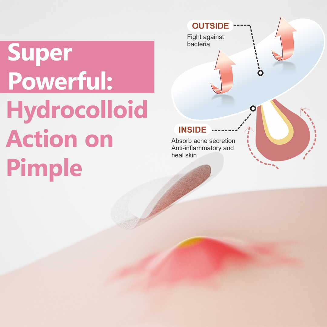 6 acne amazon creatives